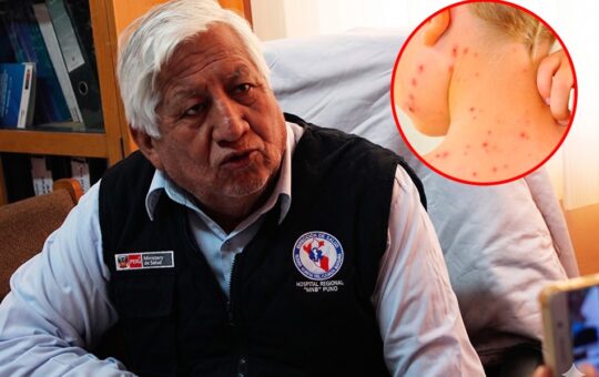 AUMENTAN CASOS DE SARAMPIÓN EN JÓVENES Y ADULTOS NO VACUNADOS, ALERTA EPIDEMIÓLOGO PERCY CASAPERALTA – RCR Peru