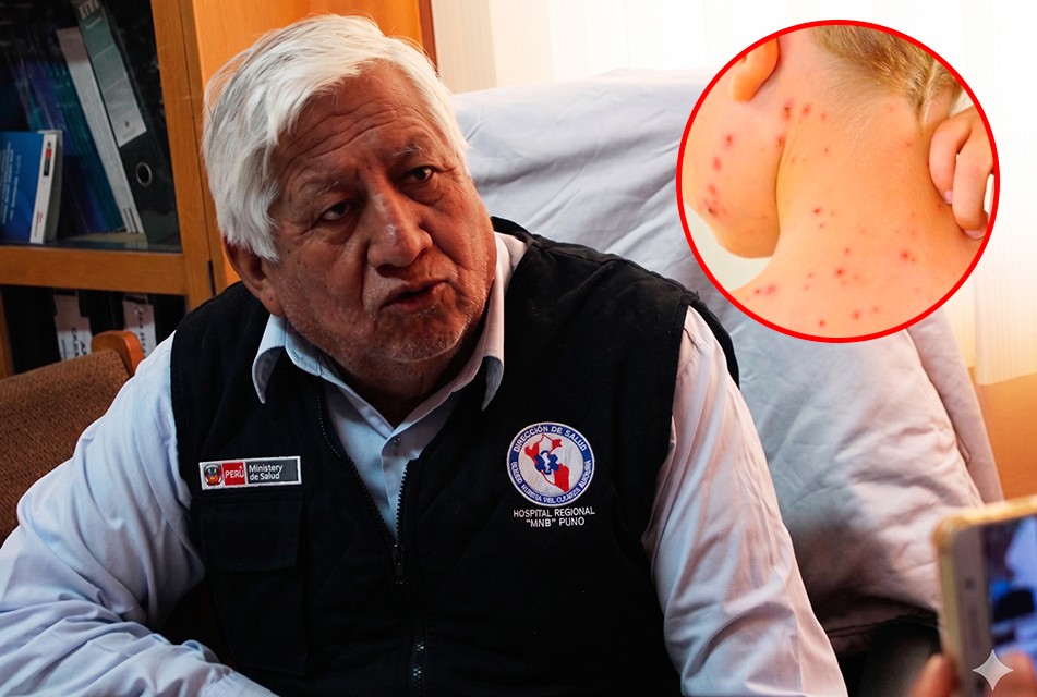 AUMENTAN CASOS DE SARAMPIÓN EN JÓVENES Y ADULTOS NO VACUNADOS, ALERTA EPIDEMIÓLOGO PERCY CASAPERALTA – RCR Peru